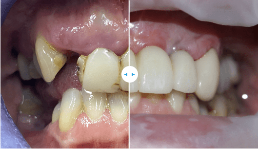 before and after photo of a persons teeth after visiting a dentist