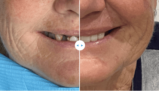 before and after photo of an old lady's teeth