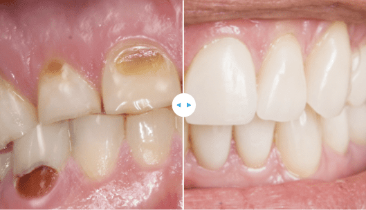 teeth damage with cavities gets treated