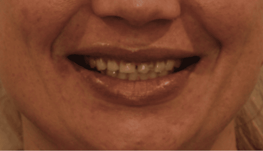 woman with damage teeth