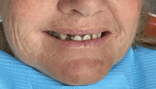 teeth with poor oral health