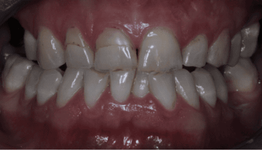 teeth with cavities and bad oral health