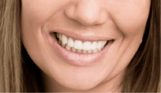 woman smiling showing her teeth