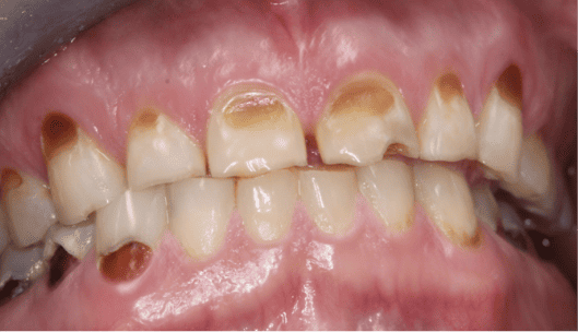 damage teeth because of cavities
