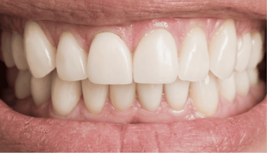 complete set of teeth