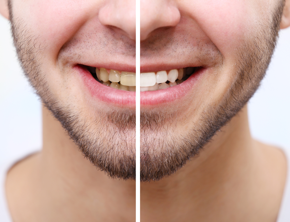 before and after concept of teeth whitening