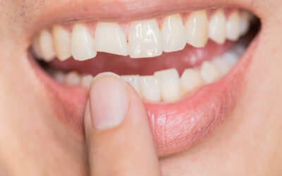 Understanding Cracked Teeth: Causes and Care And Why You Should See A Dentist ASAP.
