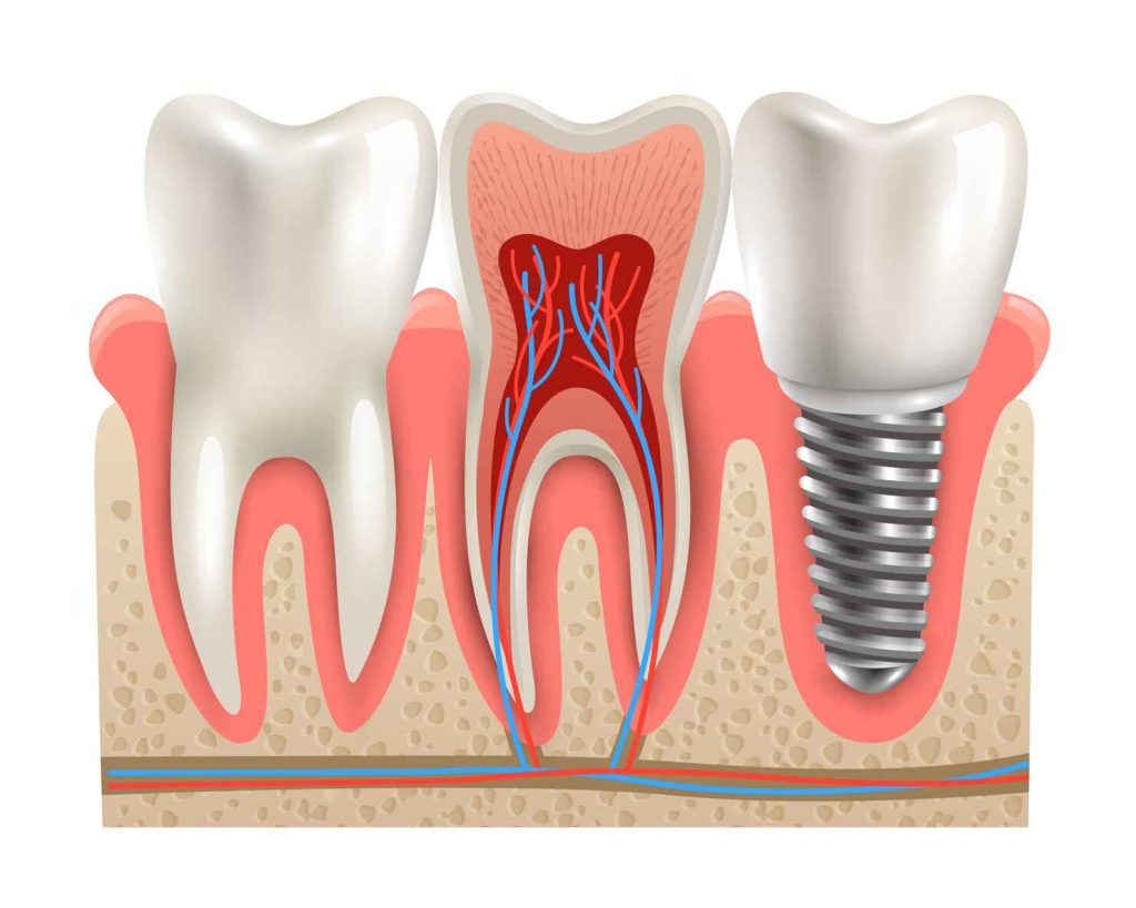 image showing roots of teeth as compared with tooth implants