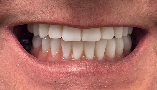 All on x full mouth implants after01