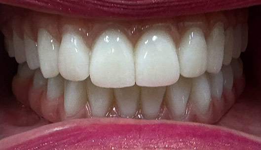 All on x full mouth implants after02