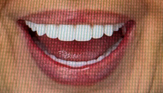 All on x full mouth implants after03