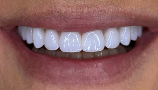 All on x full mouth implants after04