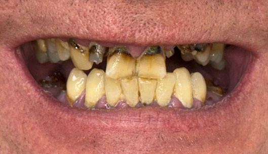 All on x full mouth implants before01