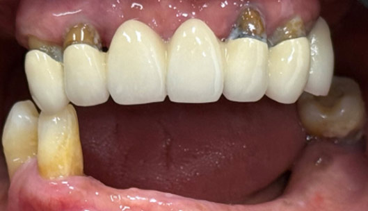 All on x full mouth implants before02