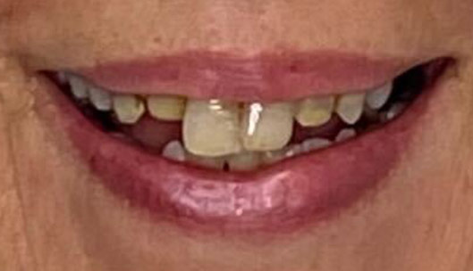 All on x full mouth implants before03