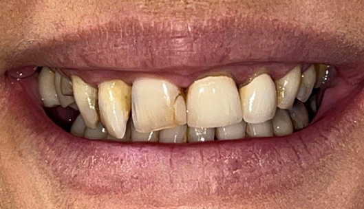 All on x full mouth implants before04